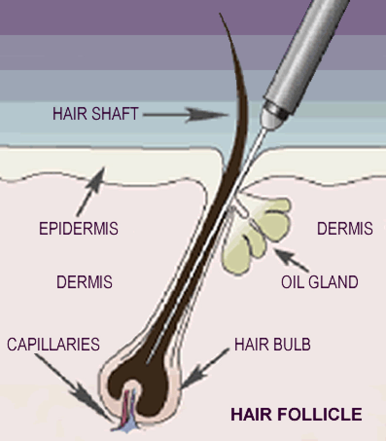 A diagram of an eletrolysis needle entering the hair shaft and zapping the hair follicle